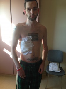 Here's me a few days after the surgery when I was able to walk a little bit